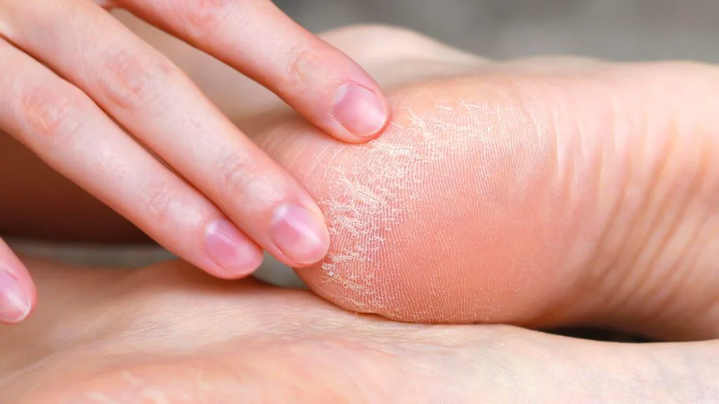 Důvodů, proč kůže na patách tvrdne, je několik