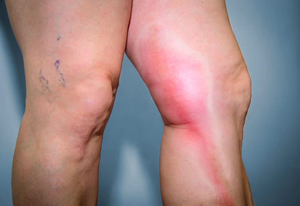 Otok na noze způsobený trombózou