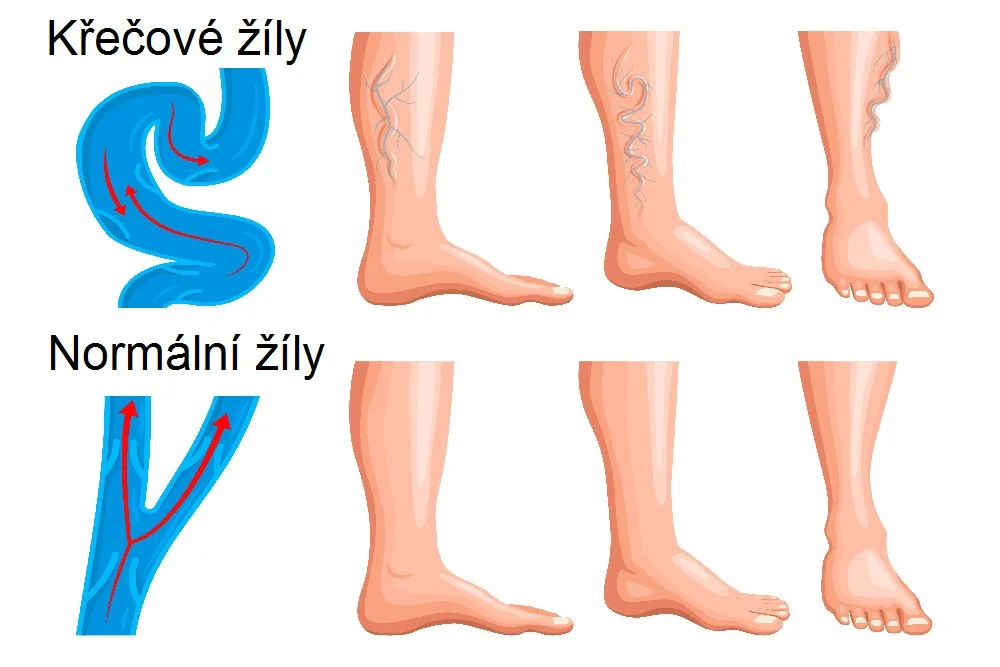 Obrázek popisující rozdíl mezi normálními a křečovými žilami
