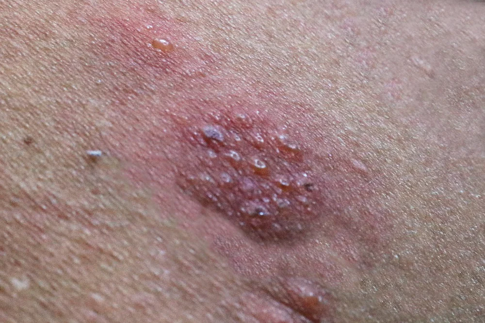 Detailní fotografie kožní vyrážky s puchýřky při pásovém oparu