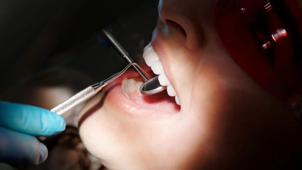 Profesionální bělení v ordinaci